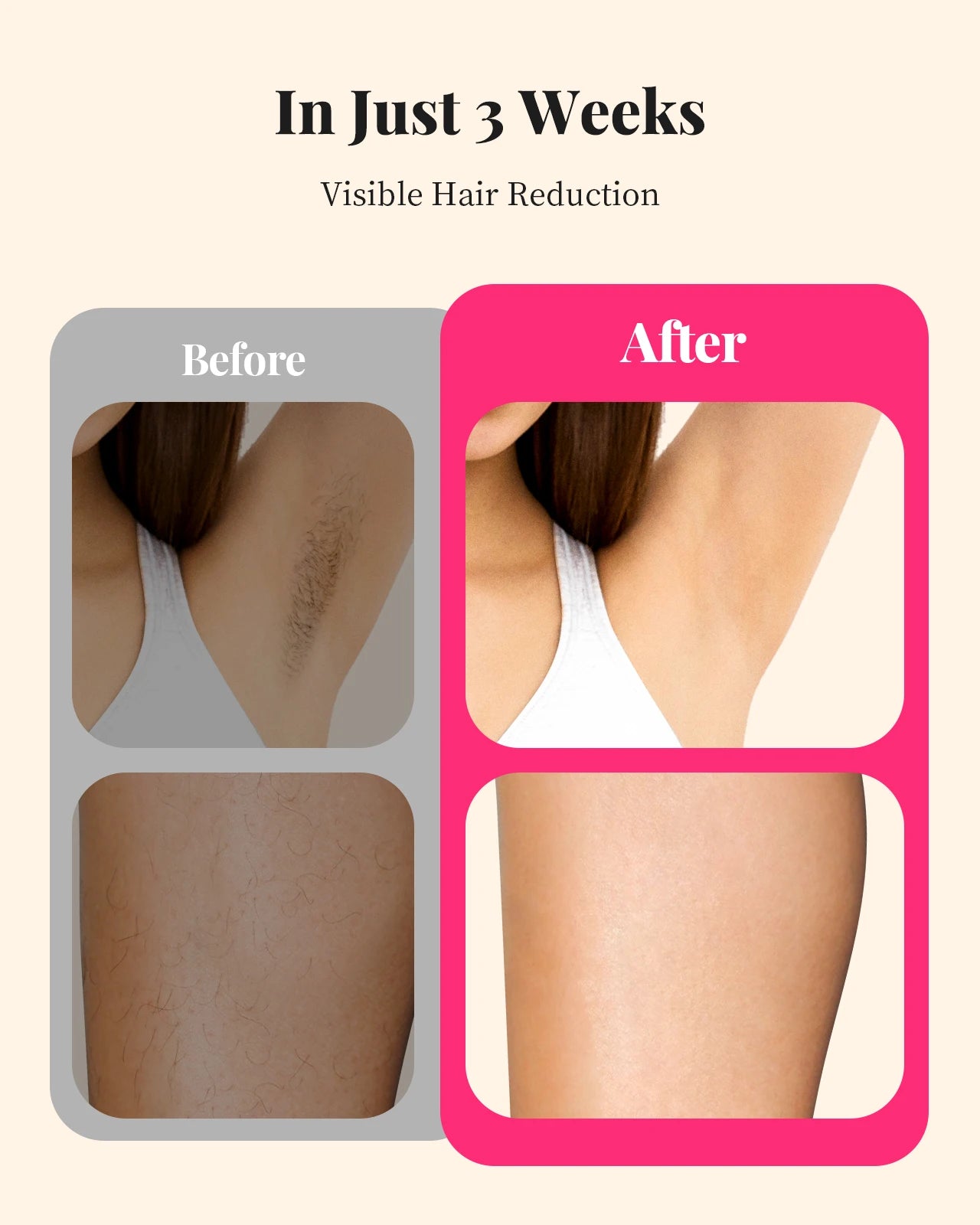 Totmizby IPL Painless Permanent Hair Removal System Body And Face